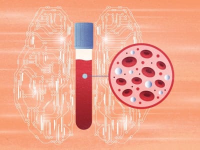 Metode AI 'Fragle' Mempermudah dan Mempercepat Pemantauan Kanker Lewat Darah