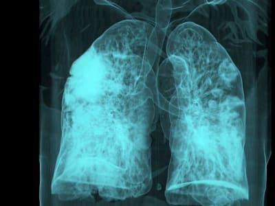 Infeksi COVID-19 Bisa Bangkitkan Sel Kanker Dormant dan Tingkatkan Risiko Kematian