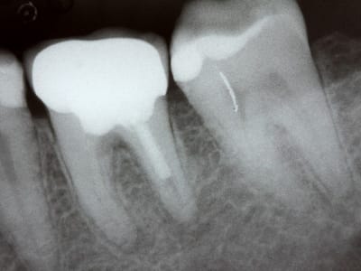 Bakteri Gusi Porphyromonas gingivalis Bisa Sebabkan Gangguan Irama Jantung AFib