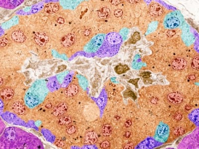 Terobosan Terapi Diabetes: Sel Edit Gen CRISPR Produksi Insulin Tanpa Obat Imun