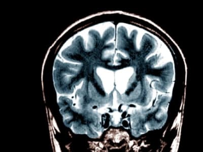 Terapi Gen Baru Memperlambat Perkembangan Penyakit Huntington Hingga 75%