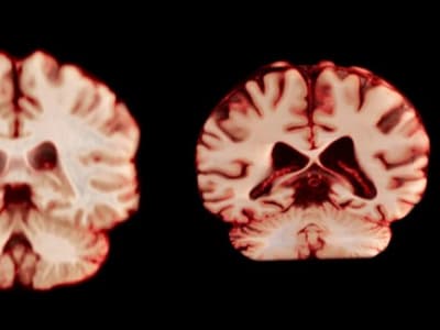 Menurunnya Volume Otak Pria Lebih Cepat, Kenapa Wanita Lebih Sering Alzheimer?
