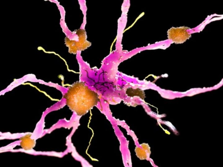 Seorang pria ditakdirkan untuk mengalami Alzheimer dini — gen-gen ini mungkin menjelaskan pelariannya.
