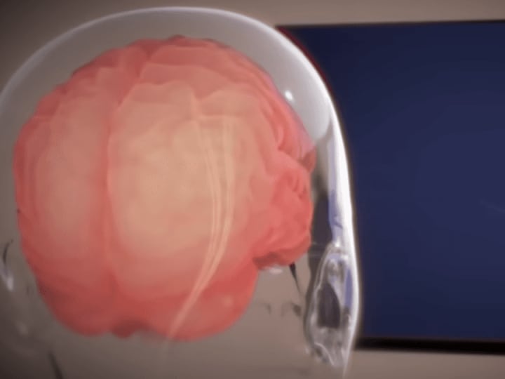 Neuralink Elon Musk akan menguji chip otak yang mengubah permainan untuk mengendalikan lengan robot.