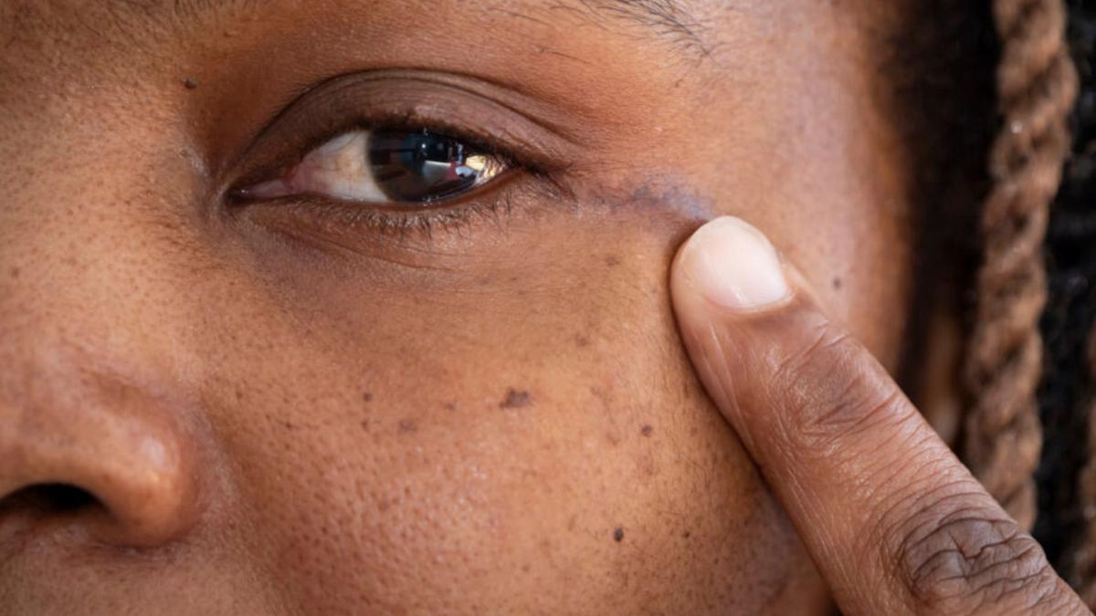 Operasi Tumor Otak Lewat Mata, Terobosan Minim Invasif Pertama di Inggris