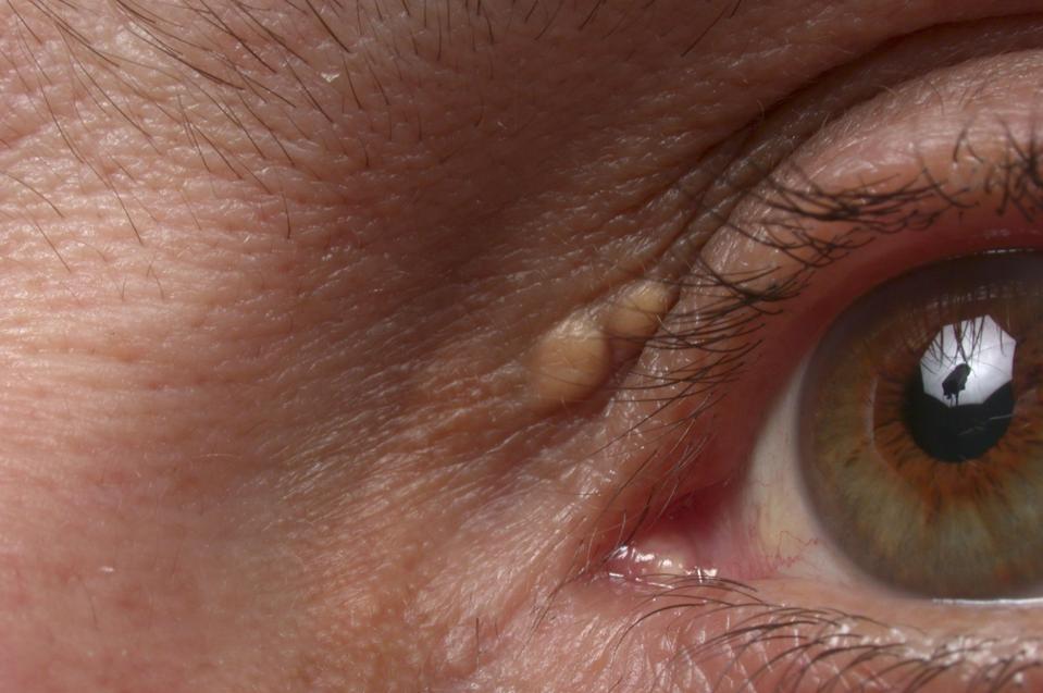 Diet Karnivora Ekstrem Picu Lonjakan Kolesterol dan Benjolan Kuning di Kulit