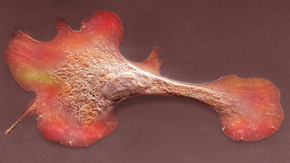 Terobosan Baru: Tambalan Otot dari Sel Punca Stabilkan Pasien Gagal Jantung