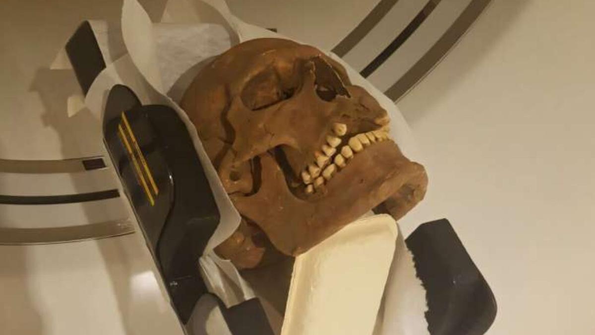 Teknologi CT Scan Ungkap Sakit Kronis dan Penderitaan Viking Abad ke-12