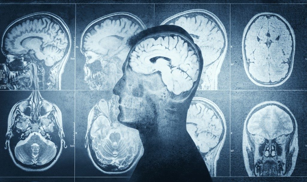 Terapi MRgFUS Non-Invasif Bantu Atasi OCD Berat Hingga 10 Tahun