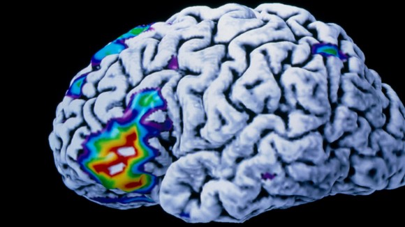 Implan Otak AI Ubah Pikiran Jadi Ucapan Real-Time Bantu Penderita Lumpuh