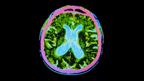 Terobosan Terapi Sel Punca Tunjukkan Harapan Baru bagi Penderita Parkinson