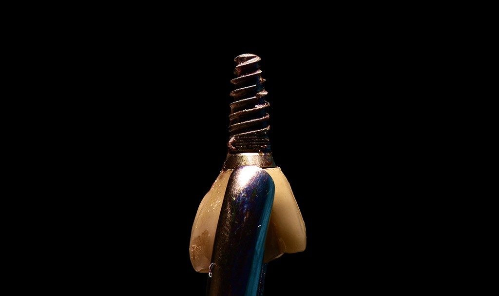 Penemuan Biomarker Baru untuk Diagnosis dan Terapi Peri-Implantitis yang Lebih Tepat