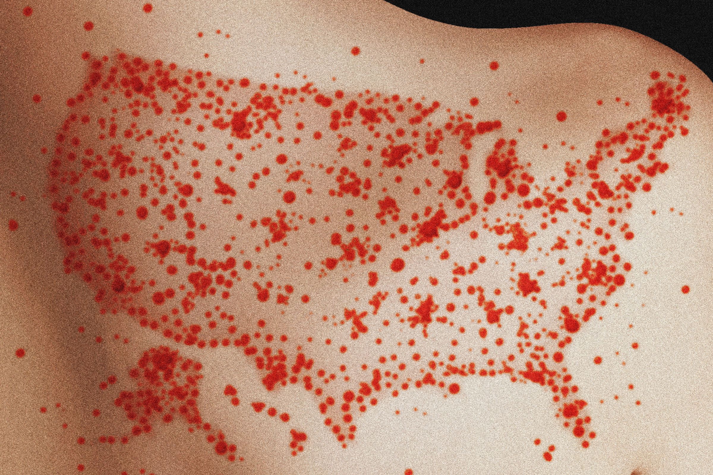 Risiko Campak Kembali Endemik di AS Akibat Penurunan Vaksinasi Anak