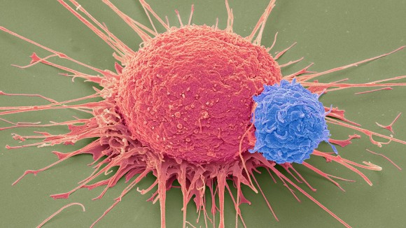 Terapi CAR-T Terbaru Perpanjang Hidup Pasien Kanker Tumor Padat di China