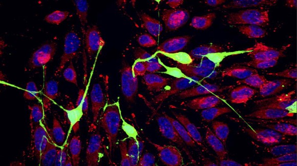 Sel Kanker Mencuri Energi dari Neuron untuk Bertahan dan Menyebar