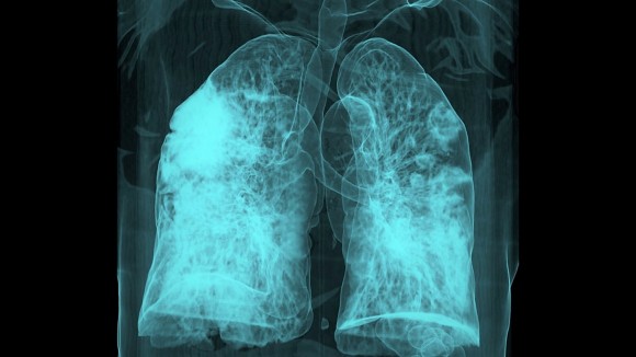 Infeksi COVID-19 Bisa Bangkitkan Sel Kanker Dormant dan Tingkatkan Risiko Kematian