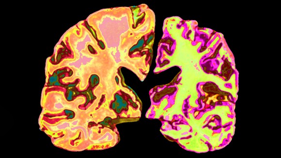 Pengisian Lithium Alami di Otak Bisa Membalikkan Alzheimer Secara Revolusioner