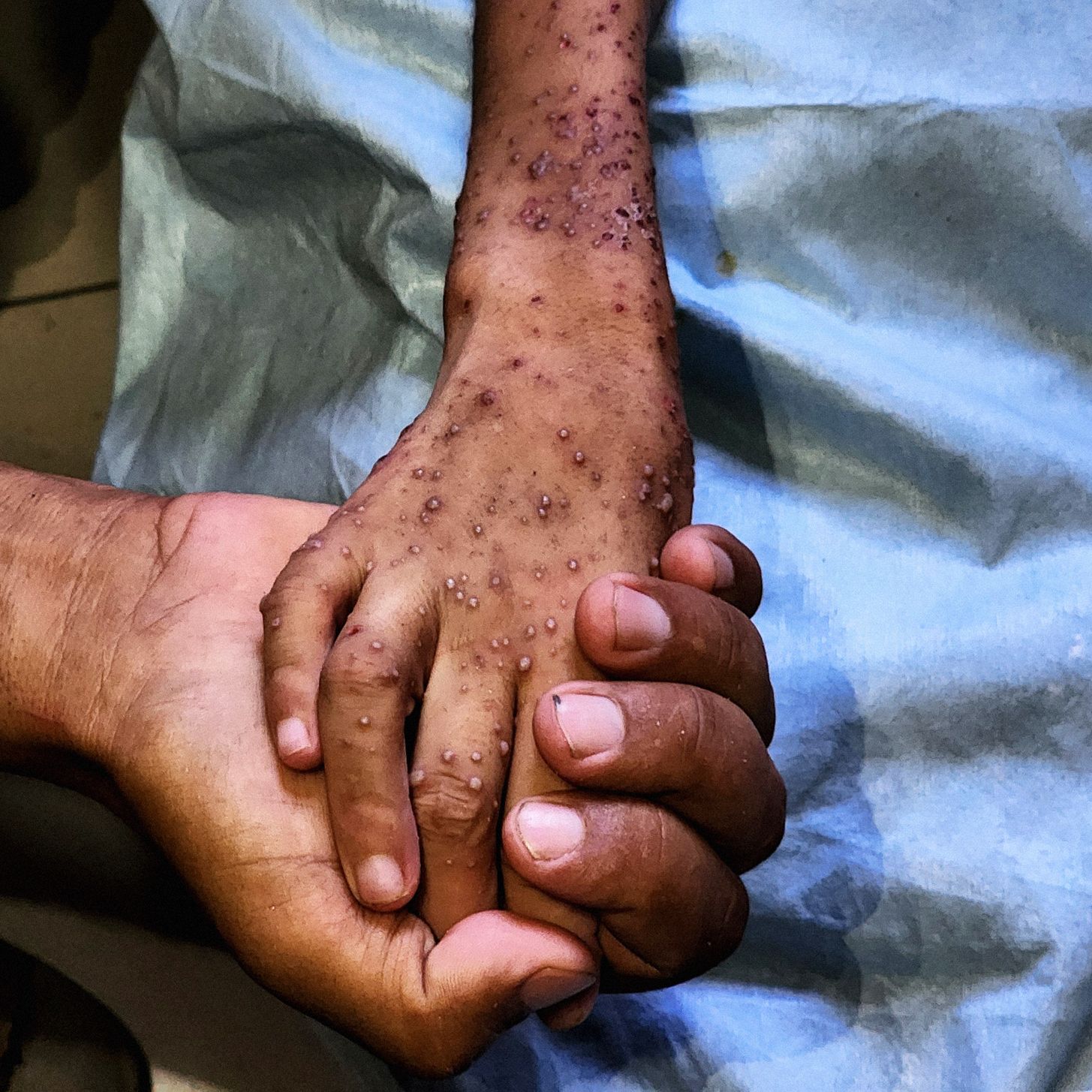 Meningkatnya Krisis Malnutrisi Mematikan di Gaza dan Dampak Jangka Panjangnya