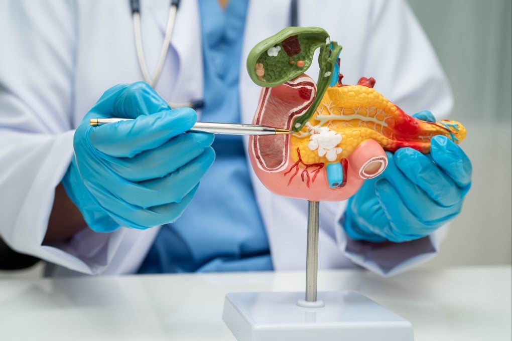 Alat Genomik Baru Mengubah Deteksi Dini dan Pengobatan Kanker Pankreas