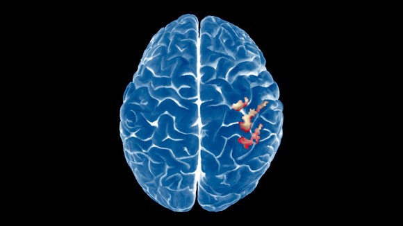 Penelitian Baru: Peta Otak Tidak Berubah Setelah Amputasi Lengan