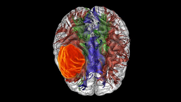Terobosan Terbesar: Menghambat Pertumbuhan Glioblastoma dengan Diet Serin Rendah