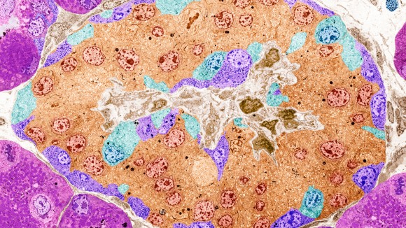 Terobosan Terapi Diabetes: Sel Edit Gen CRISPR Produksi Insulin Tanpa Obat Imun