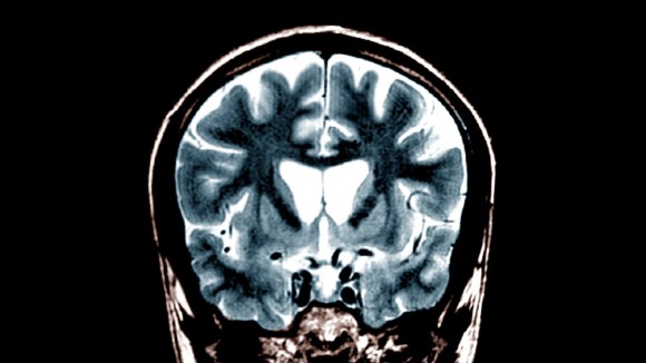 Terapi Gen Baru Memperlambat Perkembangan Penyakit Huntington Hingga 75%