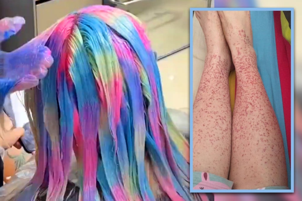 Wanita Terkena Penyakit Ginjal Setelah Sering Ganti Warna Rambut Ikuti Idola K-pop