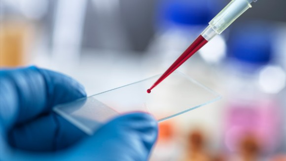 Tes Darah Epigenetik Baru Bisa Mendiagnosis Sindrom Kelelahan Kronis Secara Akurat