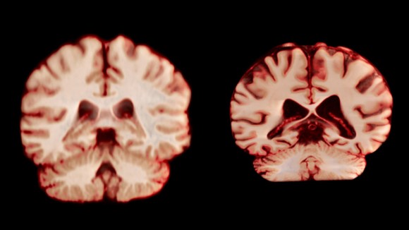 Menurunnya Volume Otak Pria Lebih Cepat, Kenapa Wanita Lebih Sering Alzheimer?