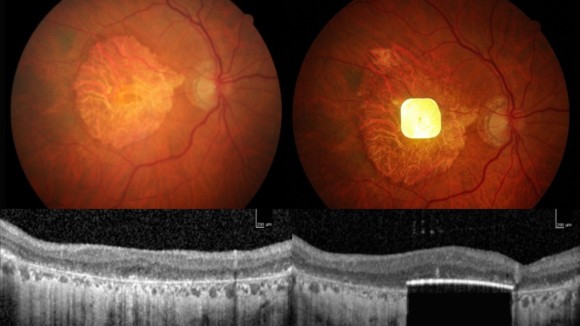 Implan Retina Mini Mengembalikan Penglihatan untuk Penderita Degenerasi Makula
