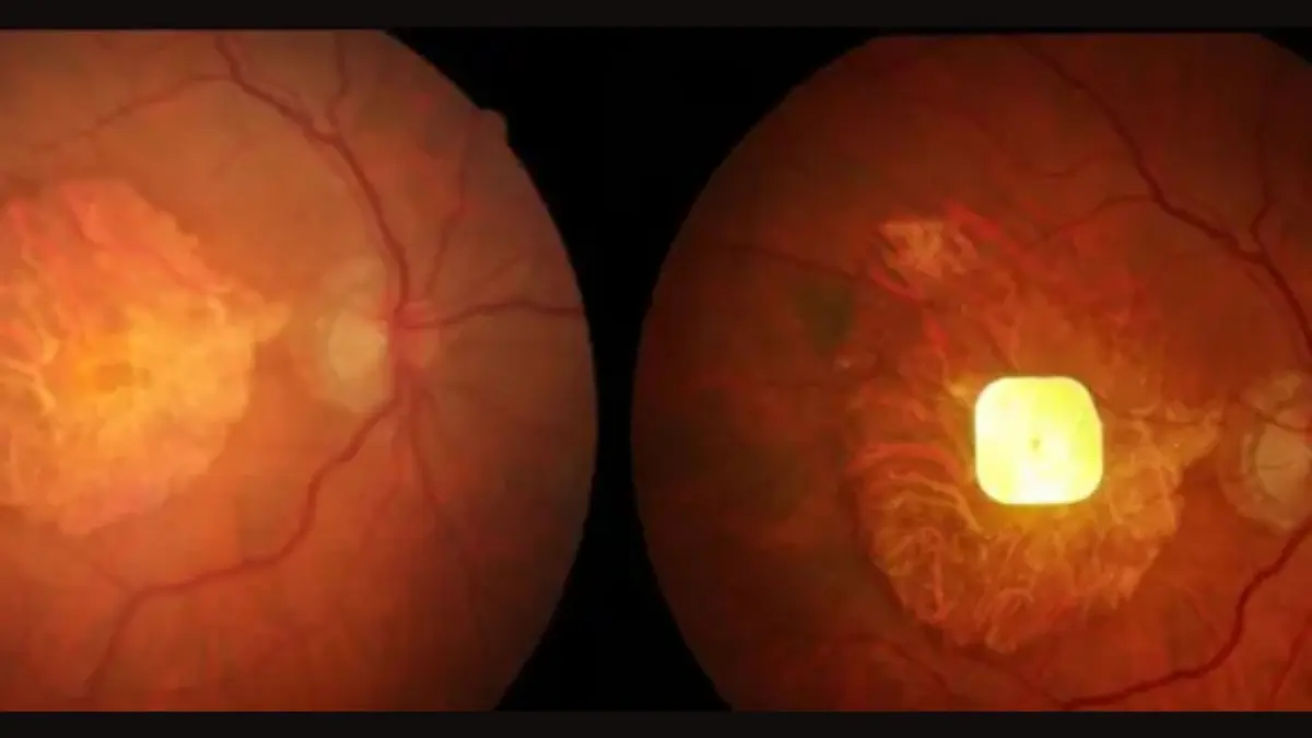 Implan Mata PRIMA Kembalikan Kemampuan Membaca pada Penderita Kebutaan