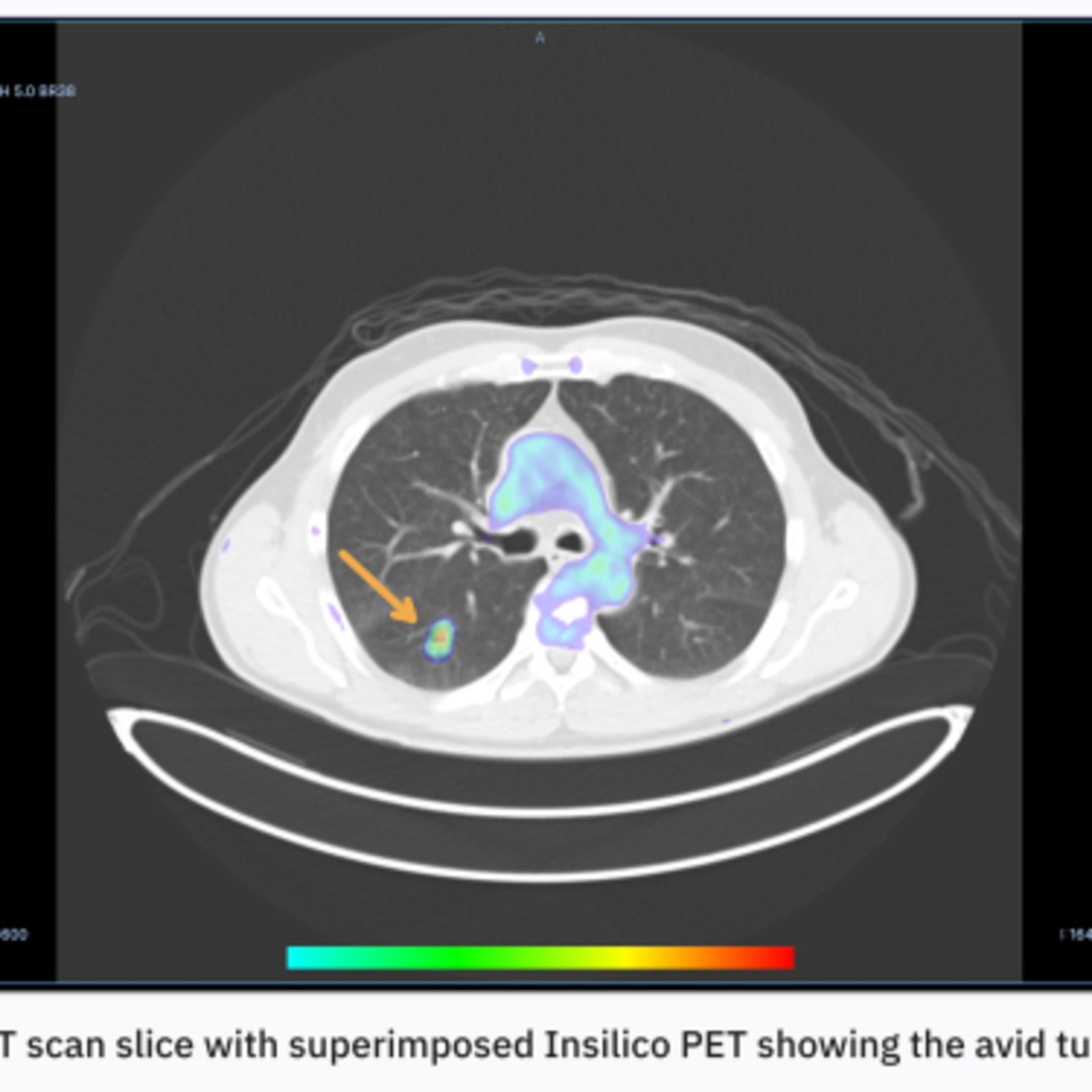 AI RADiCAIT Ubah CT Menjadi PET, Permudah Diagnosa Kanker Hidupkan Harapan Baru