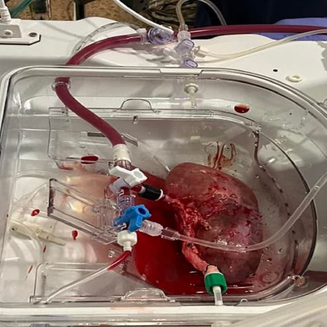 Ilmuwan Spanyol Ciptakan Ginjal Hibrida Manusia-Babi yang Berfungsi