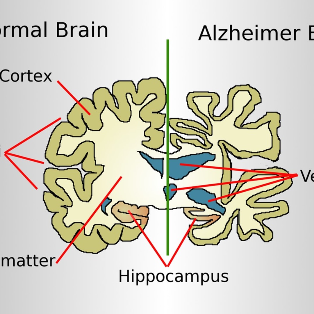 Telur dan AI Generatif: Cara Baru Kurangi Risiko Alzheimer Secara Efektif