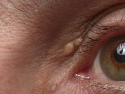 Diet Karnivora Ekstrem Picu Lonjakan Kolesterol dan Benjolan Kuning di Kulit