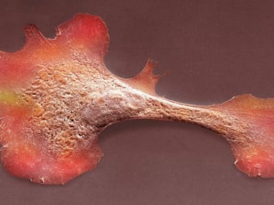 Terobosan Baru: Tambalan Otot dari Sel Punca Stabilkan Pasien Gagal Jantung