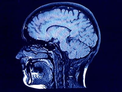 Mikroplastik Menumpuk dalam Otak Manusia: Ancaman Baru yang Mengkhawatirkan