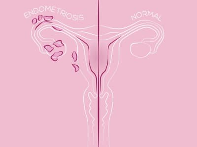 Perjuangan dan Terobosan Terbaru dalam Pengobatan Endometriosis yang Menyakitkan