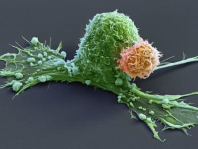 Terobosan Terapi CAR T Cells Mengatasi Kanker Neuroblastoma pada Anak