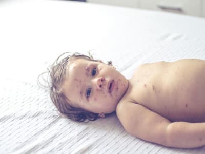 Wabah Campak Meningkat Tajam Karena Vaksinasi Turun dan Penolakan Vaksin