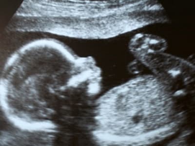 Terobosan: Bayi Pertama di Dunia Disembuhkan dari Penyakit Saraf Saat Masih Dalam Kandungan