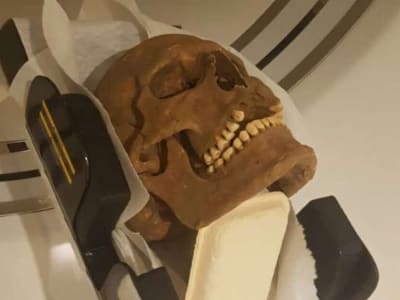 Teknologi CT Scan Ungkap Sakit Kronis dan Penderitaan Viking Abad ke-12