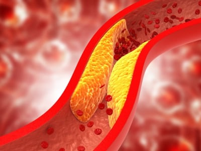 Nanovaksin Baru Cegah Penumpukan Plak Penyebab Serangan Jantung