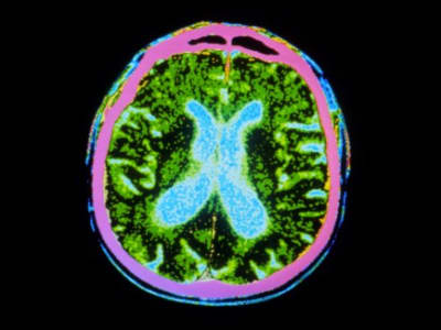 Terobosan Terapi Sel Punca Tunjukkan Harapan Baru bagi Penderita Parkinson