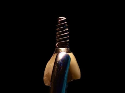 Penemuan Biomarker Baru untuk Diagnosis dan Terapi Peri-Implantitis yang Lebih Tepat