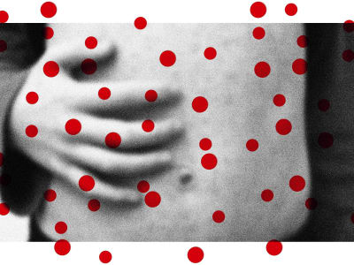 Wabah Pertusis dan Campak Meningkat: Pentingnya Vaksinasi Anak di AS