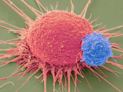 Terapi CAR-T Terbaru Perpanjang Hidup Pasien Kanker Tumor Padat di China