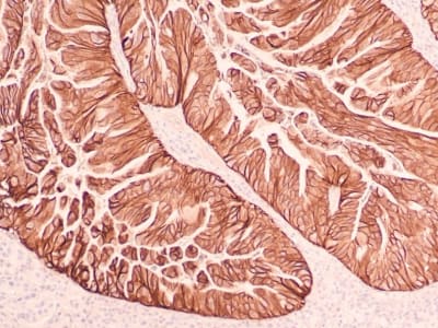 Pemetaan Canggih Tumor Lambung Buka Jalan Untuk Terapi Kanker yang Lebih Tepat