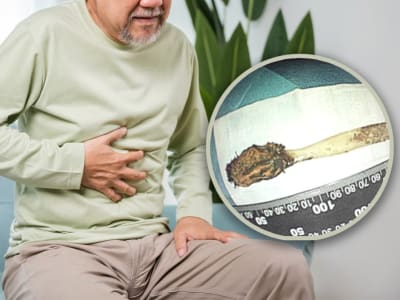 Pria 64 Tahun Operasi 80 Menit Angkat Sikat Gigi dalam Usus Selama 52 Tahun